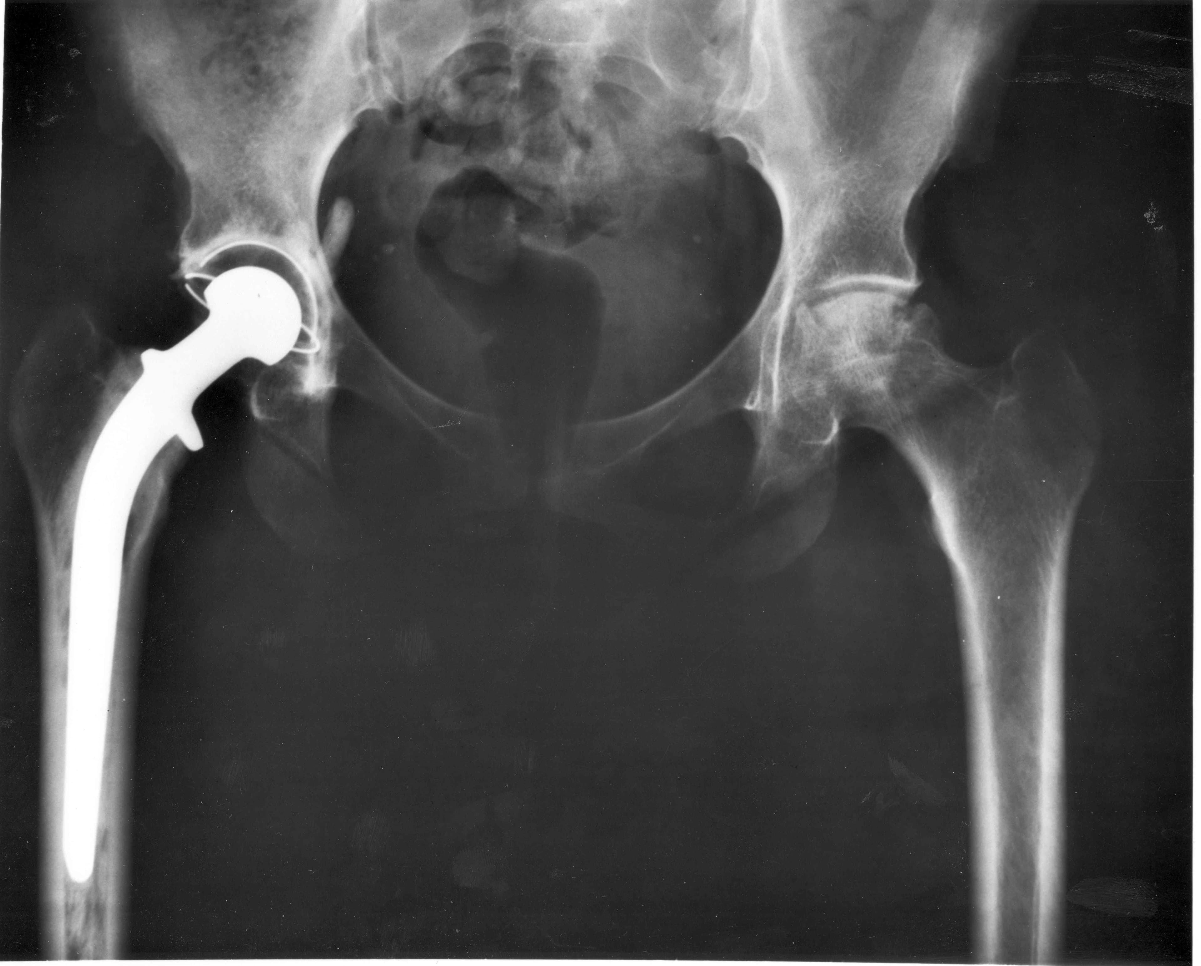 DePuy ASR 인공고관절 결함 은폐와 25억 달러 리콜 사태